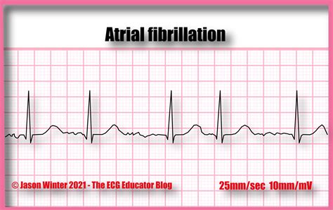 Atrial Fibrillation ECG reading