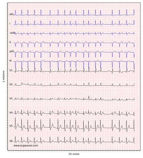 Atrial Fibrillation EKG