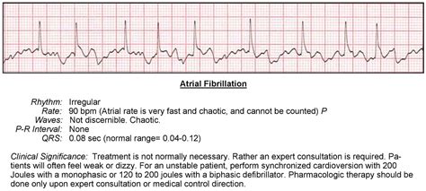 Atrial fibrillation EKG interpretation