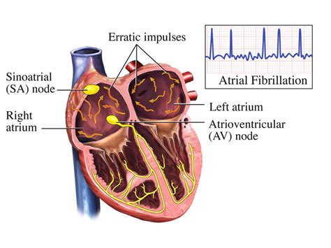 Atrial Fibrillation heart chambers