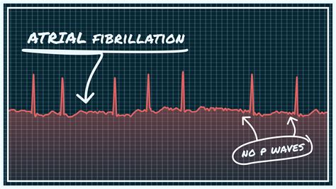 Atrial Fibrillation monitoring