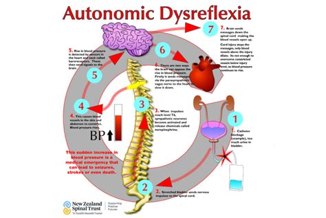 Managing Autonomic Dysreflexia