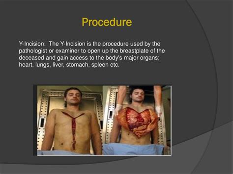 Description of Autopsy Procedure