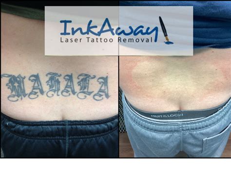 Back Tattoo Removal