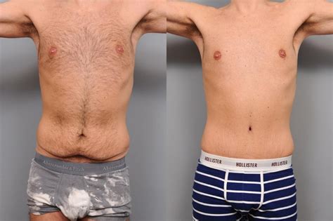 Before and After Tummy Tuck Scar Tattoo Coverup