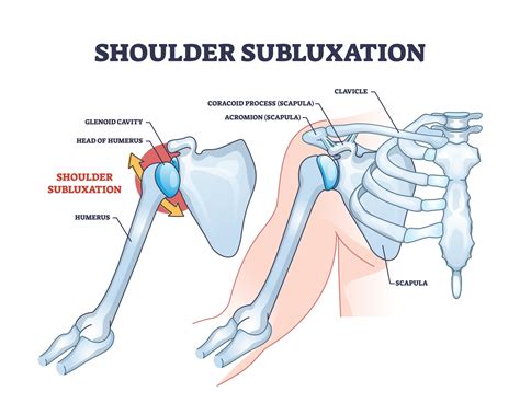 Benefits and Risks of Treatment Options for Subluxation