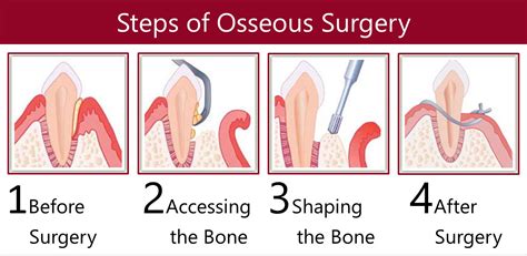 Benefits of Osteoplasty