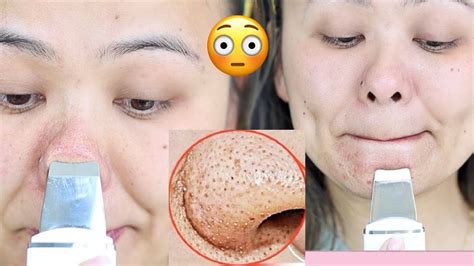 Benefits of Removing Blackheads