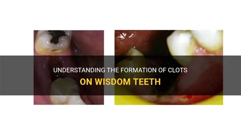 Benefits of wisdom tooth clot formation