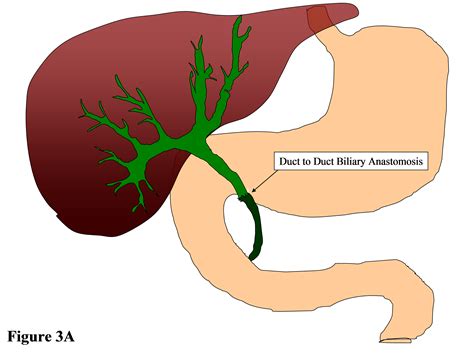 Bile Duct Obstruction