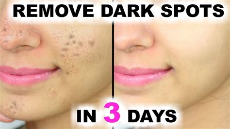 Black dots removal at home