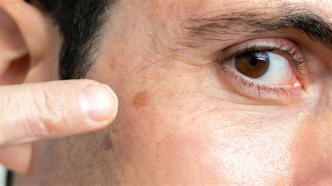 Black spots on skin