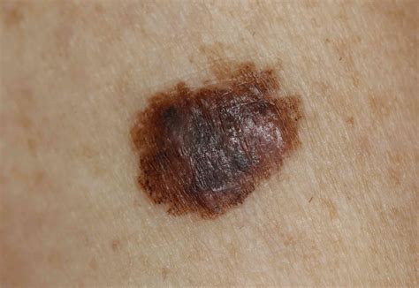 Black spots and skin cancer