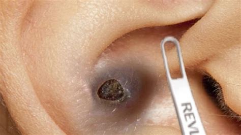 Blackhead extraction methods