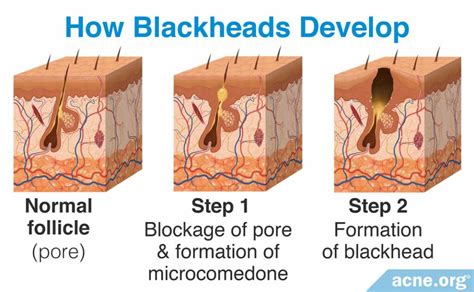 Blackhead formation process