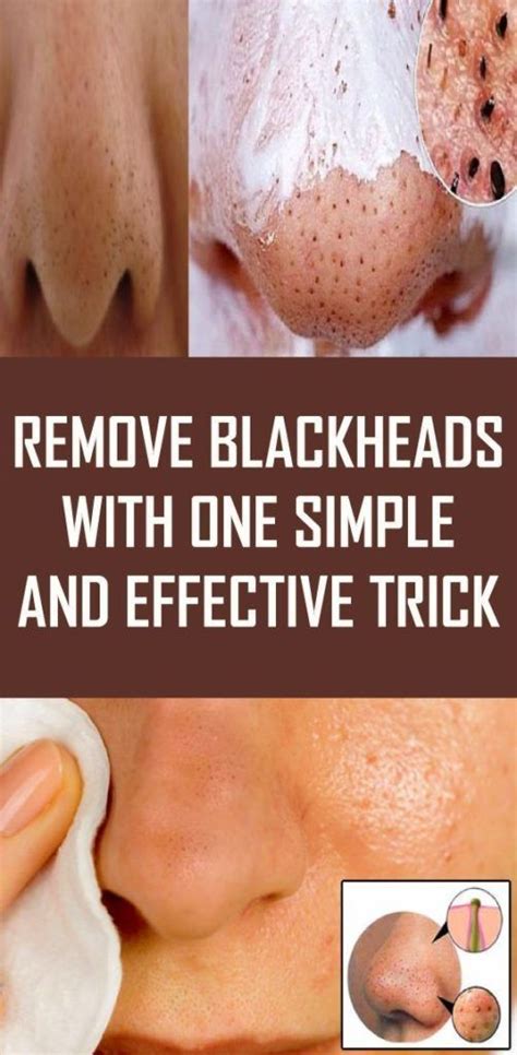 Blackhead prevention tips