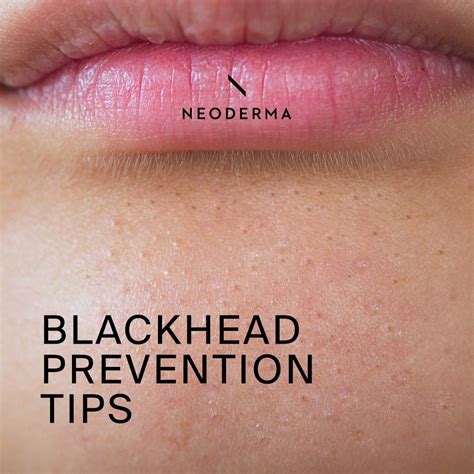 Blackhead prevention tips