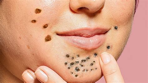 Blackhead removal after care