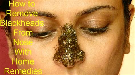 Blackhead removal home remedies