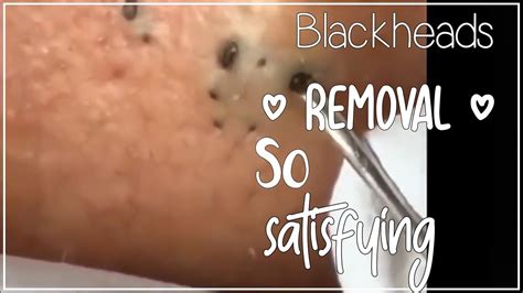 Blackhead removal professional treatments