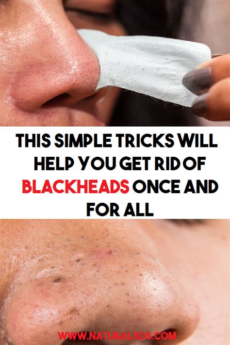 Blackhead removal tips and tricks