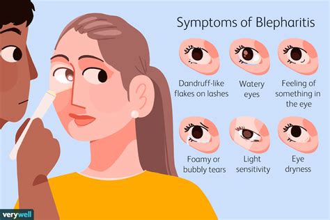 Blepharitis management