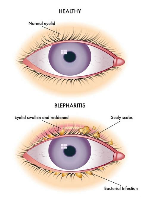 Blepharitis recovery