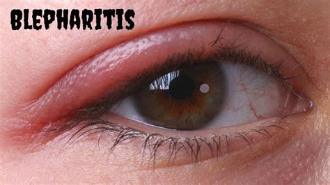 Blepharitis relief