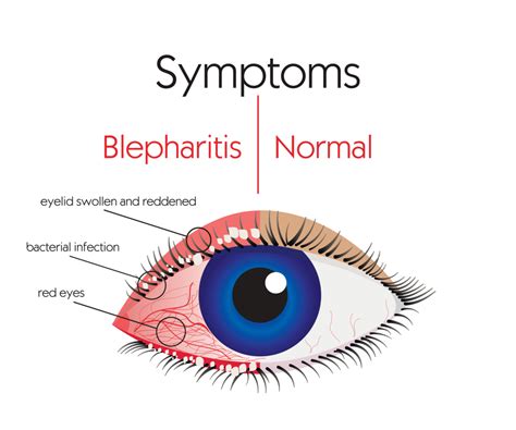 Blepharitis symptoms