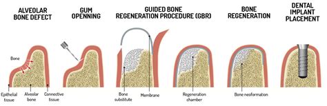 Bone Reshaping Techniques