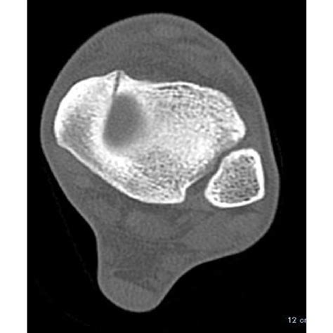 CT scan of bone spur