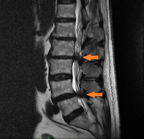 MRI of bone spur