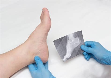 Prevention of bone spurs