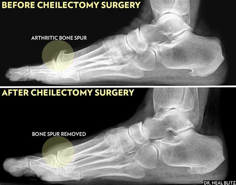 Surgery for bone spur