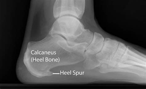 X-ray of bone spur