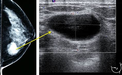 Breast Cysts