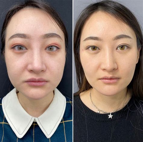 Buccal Fat Reduction for Asians