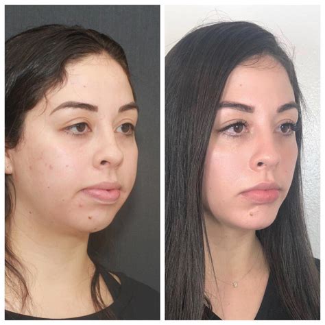 Buccal Fat Before and After Photos