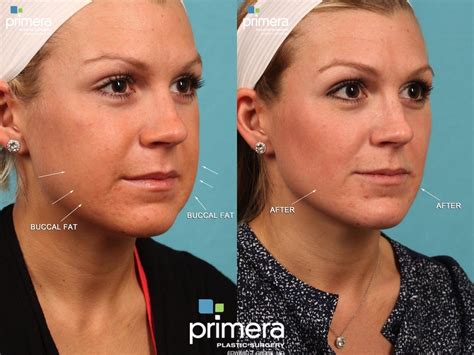 Buccal Fat Liposuction Procedure