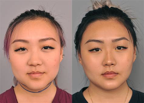 Buccal Fat Reduction Results