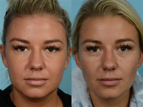 Buccal Fat Surgery Procedure