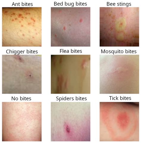 Understanding Bug Bites