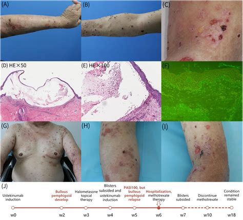 Bullous Pemphigoid Complications and Prognosis