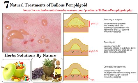 Bullous Pemphigoid Treatment Options