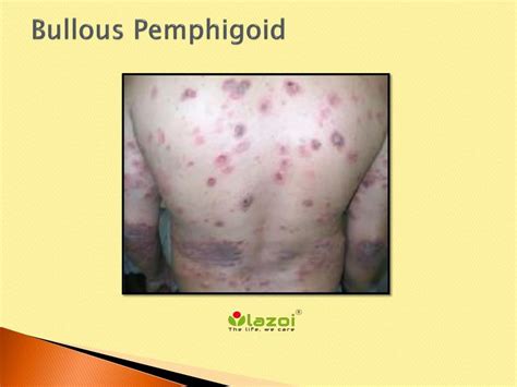 Bullous Pemphigoid Treatment Specialists