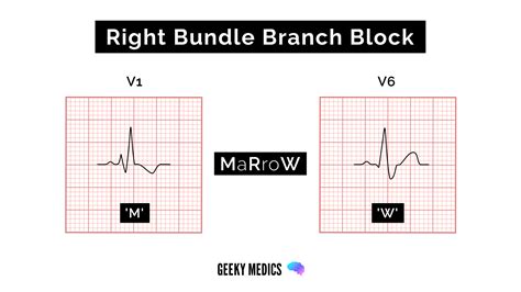 Bundle branch block EKG interpretation