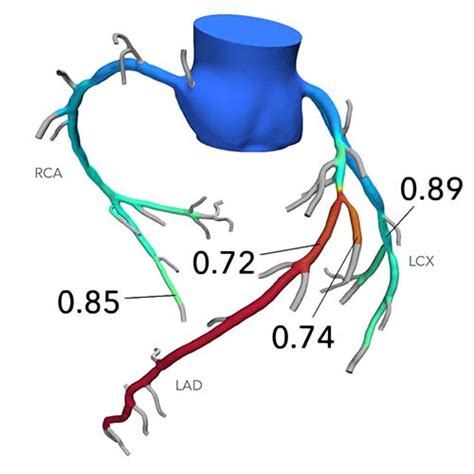 Cardiac Catheterization FFR