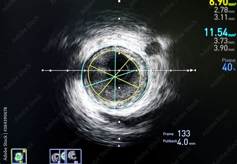 Cardiac Catheterization IVUS