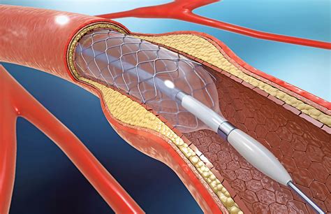 Cardiac Catheterization Procedure Steps