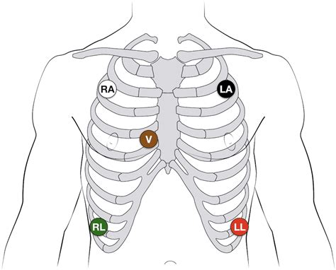 Cardiac Electrodes